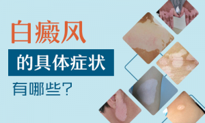 腿上長(cháng)白癜風有哪些症狀?